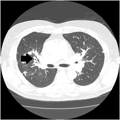 Granulomatous Sarcoidosis Mimics